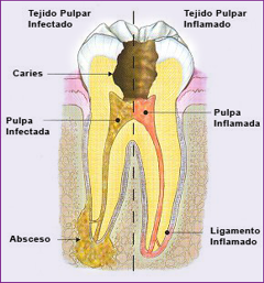 endodoncias-img2